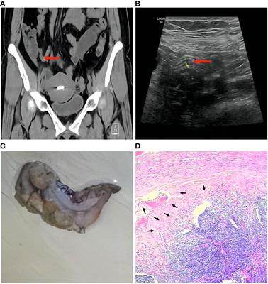 A case report of Pseudomonas citronellolis and Escherichia coli isolated from acute suppurative appendicitis: reveals the potential intestinal colonization and pathogenicity of Pseudomonas citronellolis